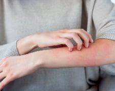Skin Rash SM